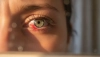 # Scopri perché ci si rompono i capillari negli occhi

## Cosa sono i capillari oculari?

Gli occhi 