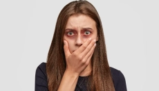 Come trattare i lividi con metodi naturali comprovati